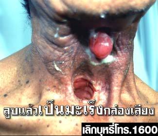Pictorial warning in Thailand / Source: http://www.tobaccolabels.ca